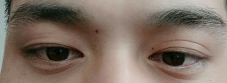 三眼皮是怎么回事?
