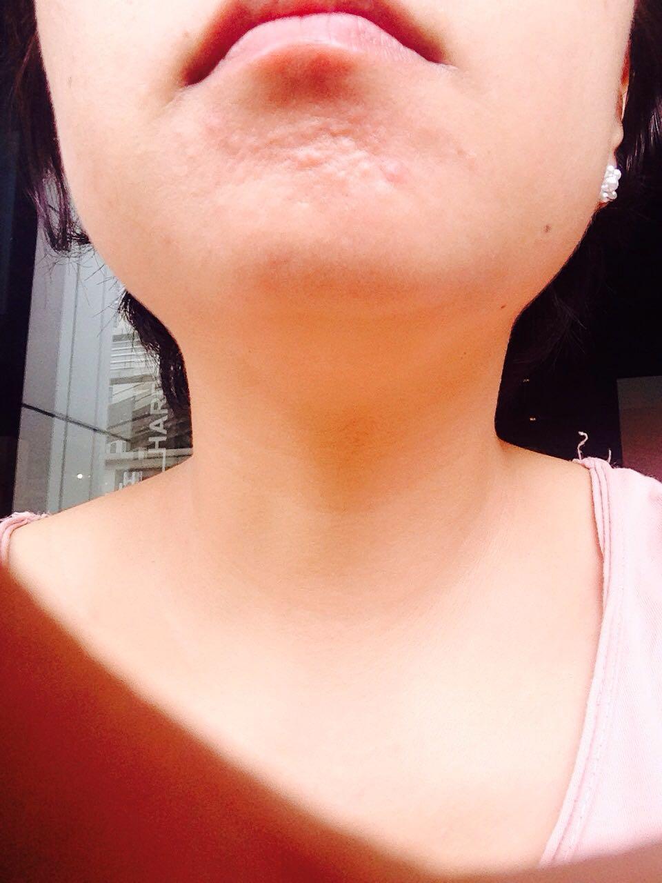 下巴皮肤下面好多小突起,不红不痒,好多年了,求问有什么方法消掉,谢谢