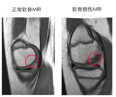 软骨专题 关节软骨损伤的治疗 知乎