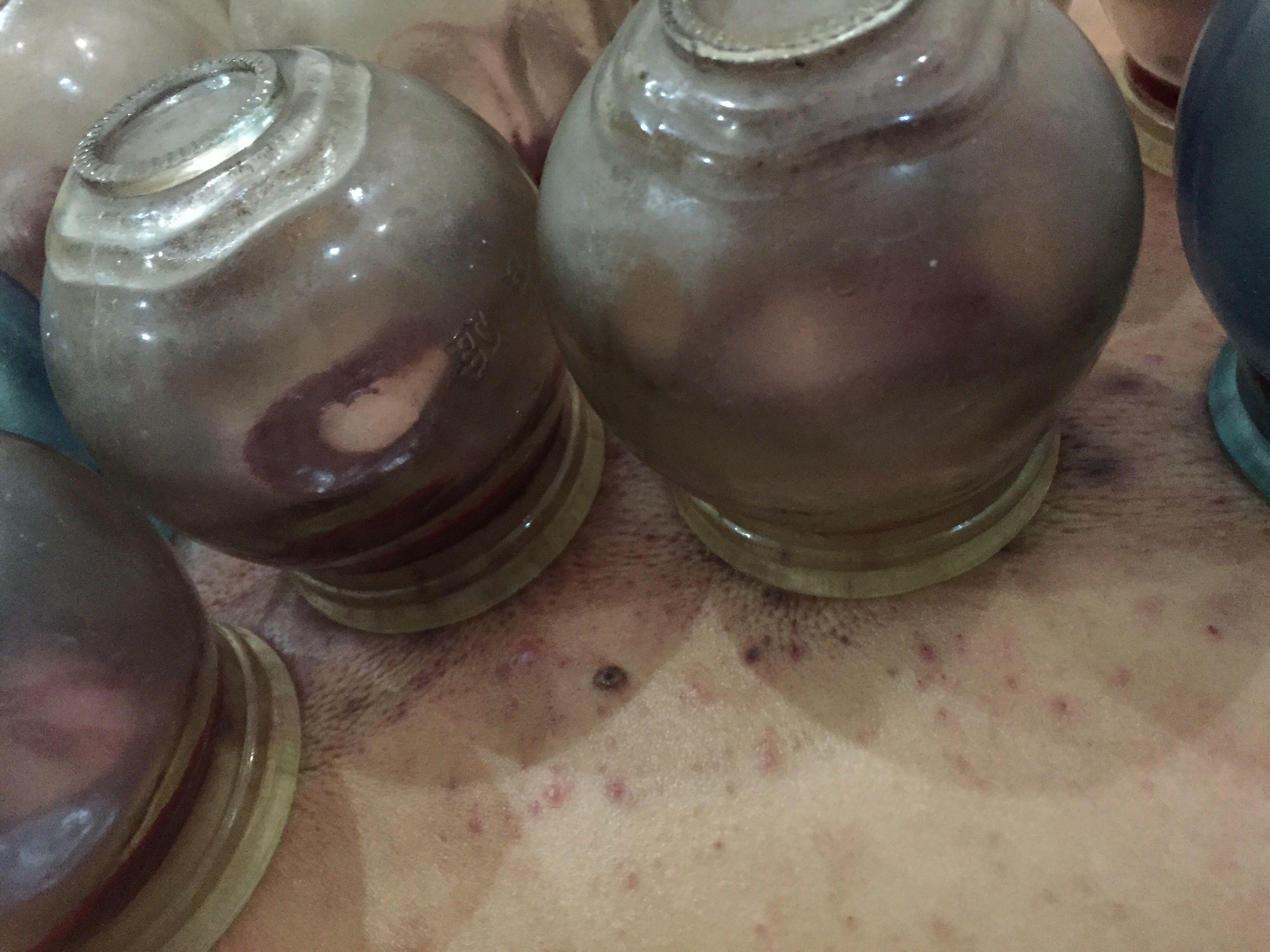 拔血罐的科学根据是什么?有没有亲身经历者能描述一下真实效果?