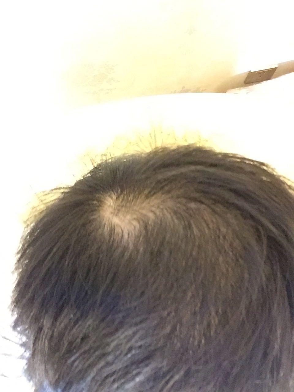 一年多了家里人说我头顶头选附近头发特别少急