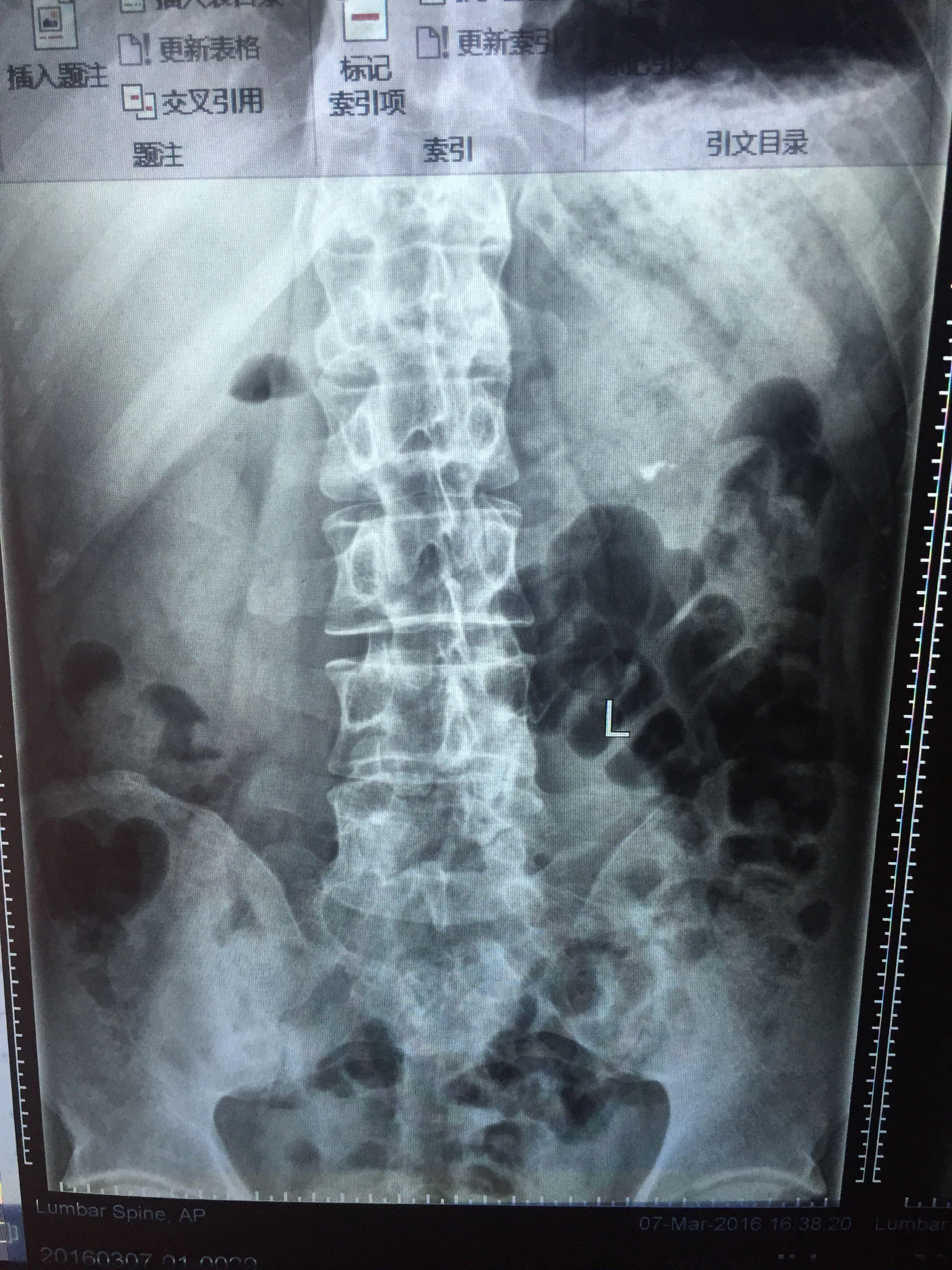 腰间盘突出片子显示很严重可是自己的症状不是很厉害还需要治疗吗