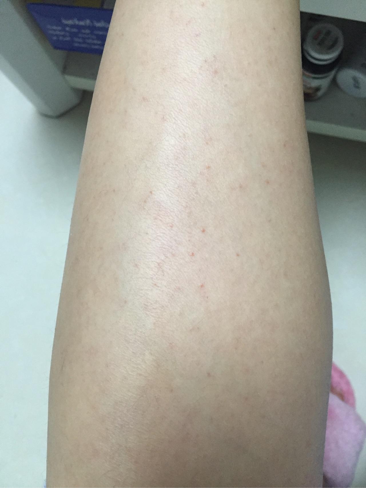 腿上莫名其妙的多了一些小红点 不疼不痒的请问是什么病? - 知乎