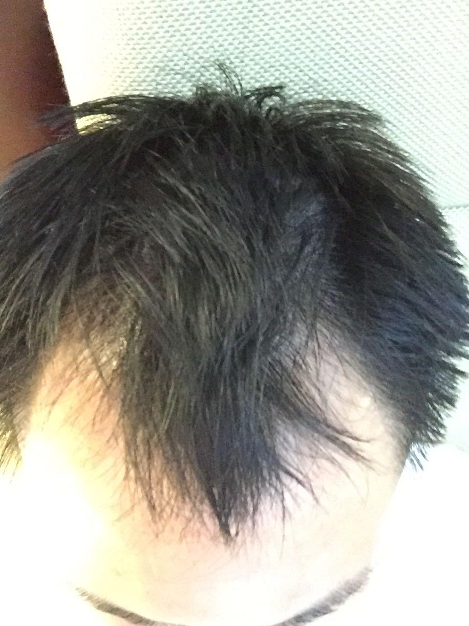 发际线越来越靠后,掉发厉害,怎么回事儿,一洗头