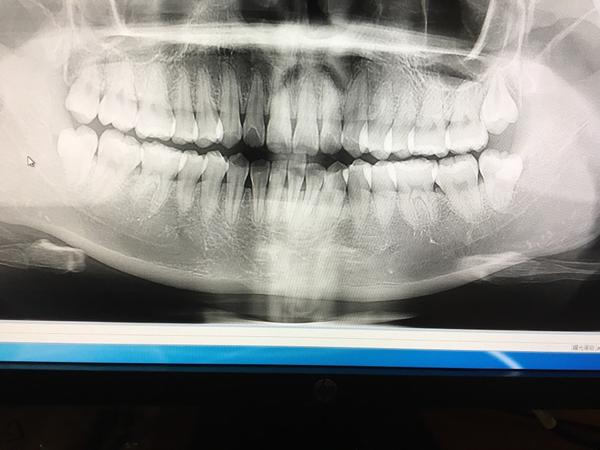 如果有脓包的话 智齿急不急着拔掉 Dentist计无谋的回答 知乎