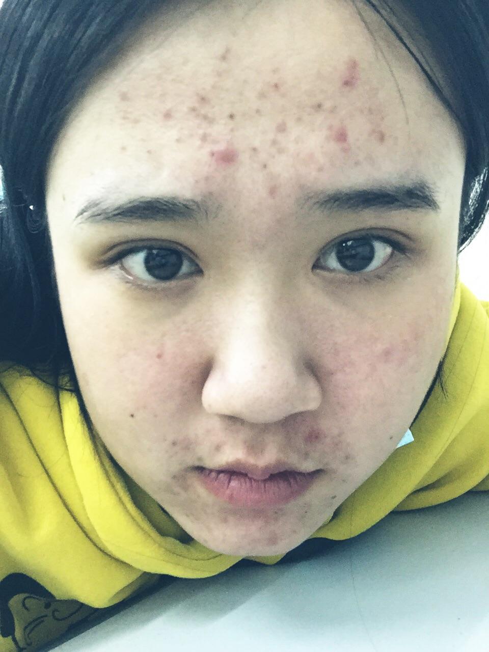 眉心长闭口痘,下巴长脓包,还有痘印怎么办?