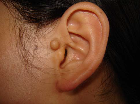 副耳我和老婆都没有副耳女儿怎么会有副耳呢