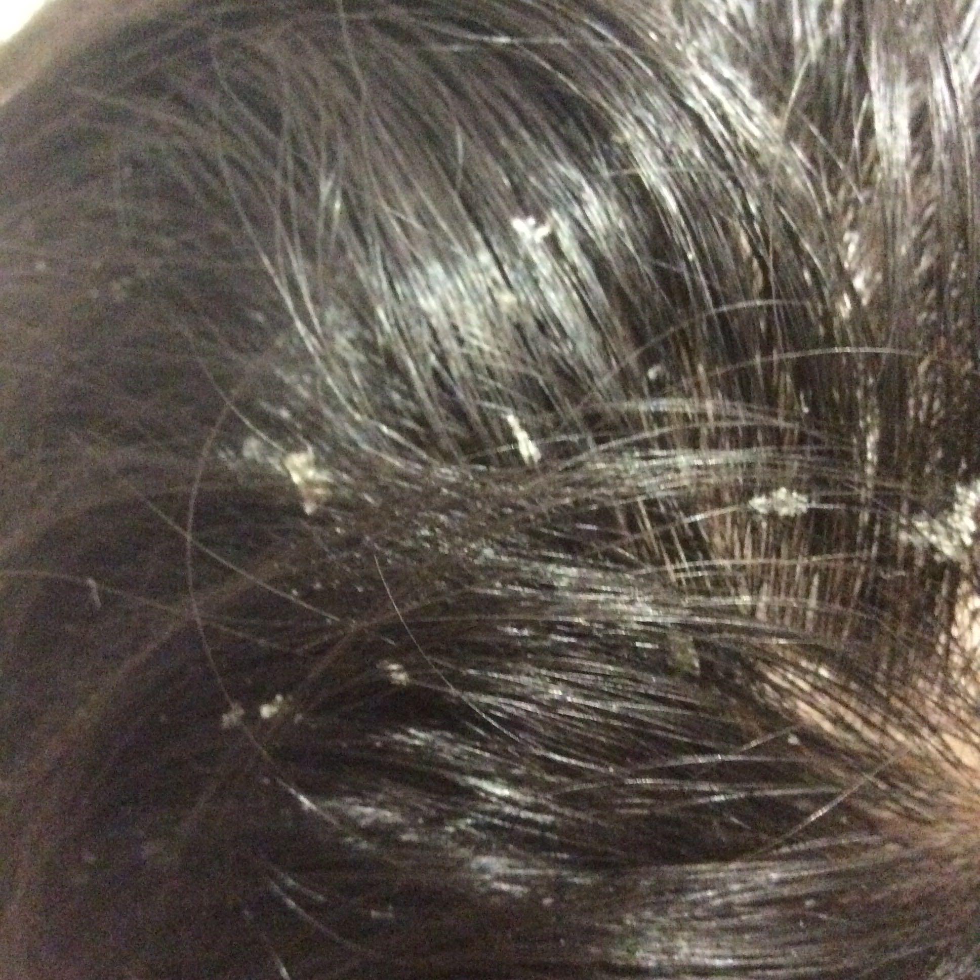 头皮屑很大块,用米醋洗的效果不持久怎么办?