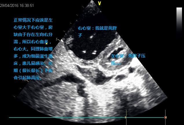 教你讀心臟彩超之房間隔缺損 - 知乎