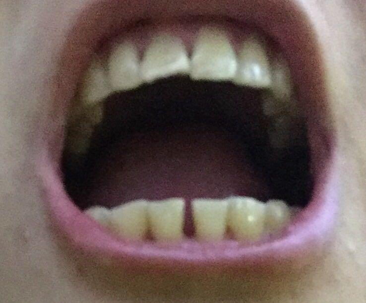 如何矫正牙缝大以及牙齿黄? - 夜黑的回答 - 知