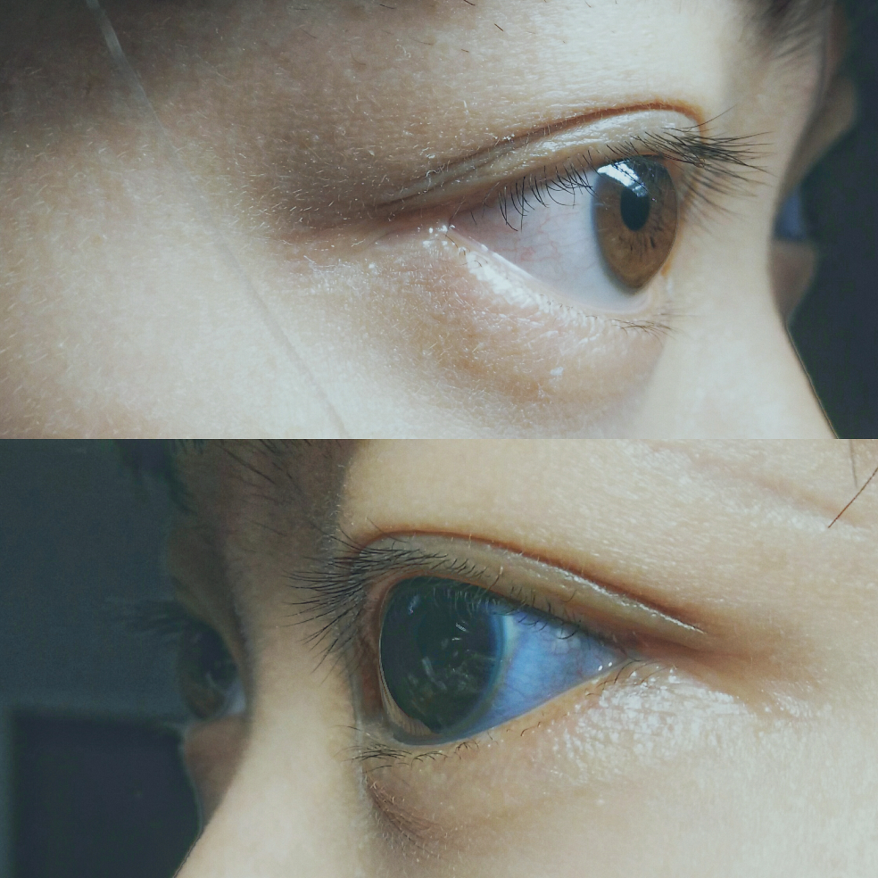 为什么我的眼白会是蓝色,天生就是这样?