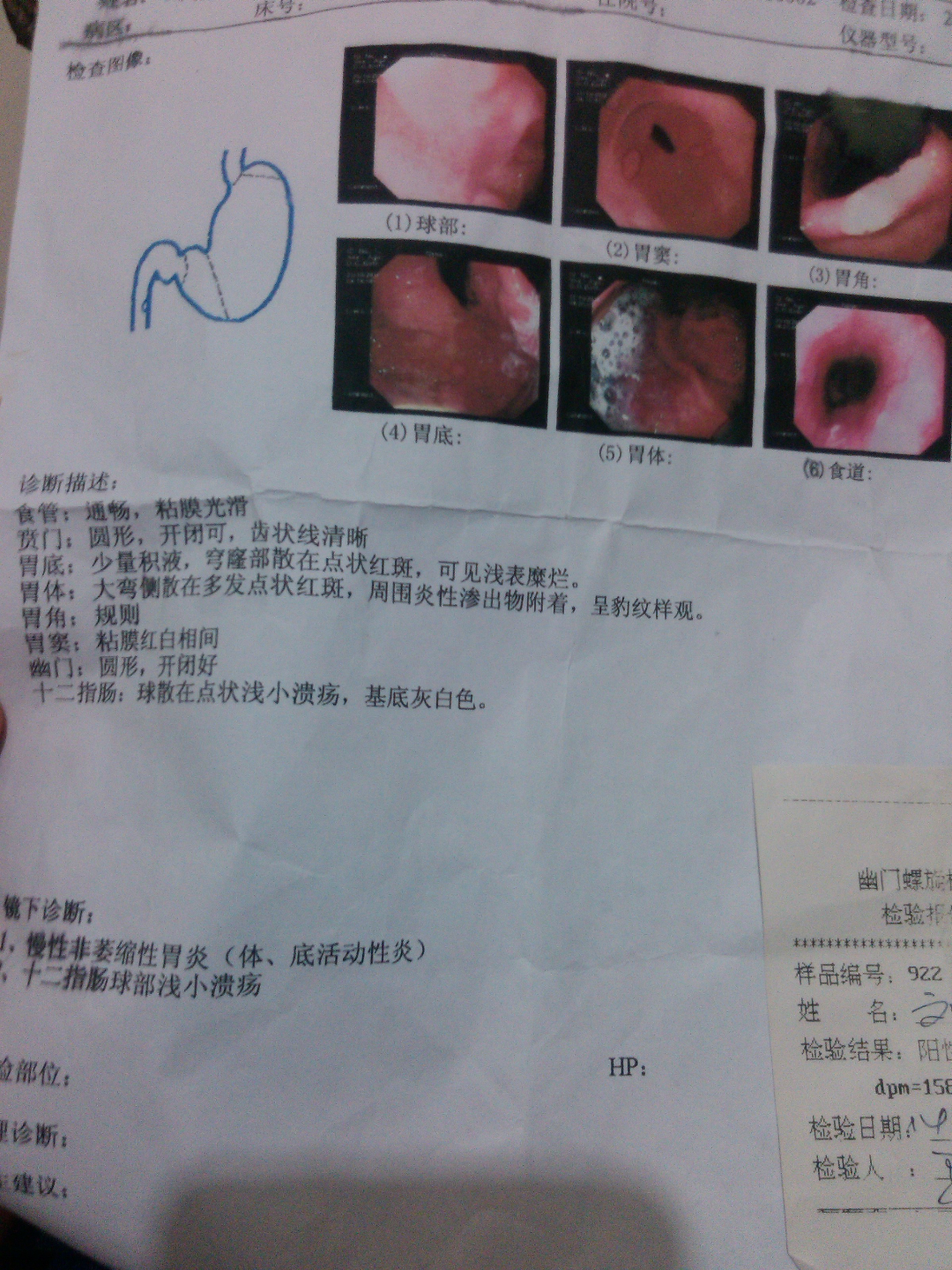 十二指肠球部多发溃疡a1期慢性浅表性胃炎伴糜烂hp有什么专业系统的