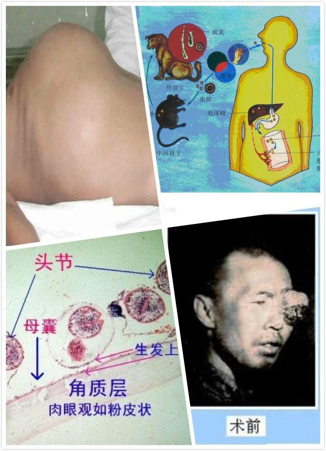 临床征象为:有缓起的腹部无痛性肿块或咳嗽,咯血等症状应怀疑为包虫病