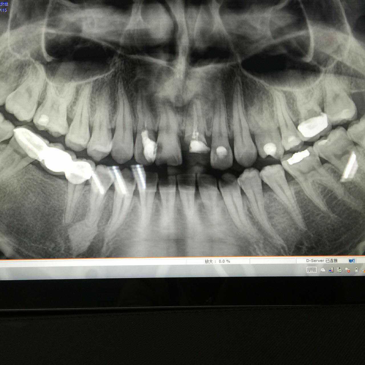 冷光牙齿美白的效果图(氟斑牙)-赵振的博客-KQ88口腔博客