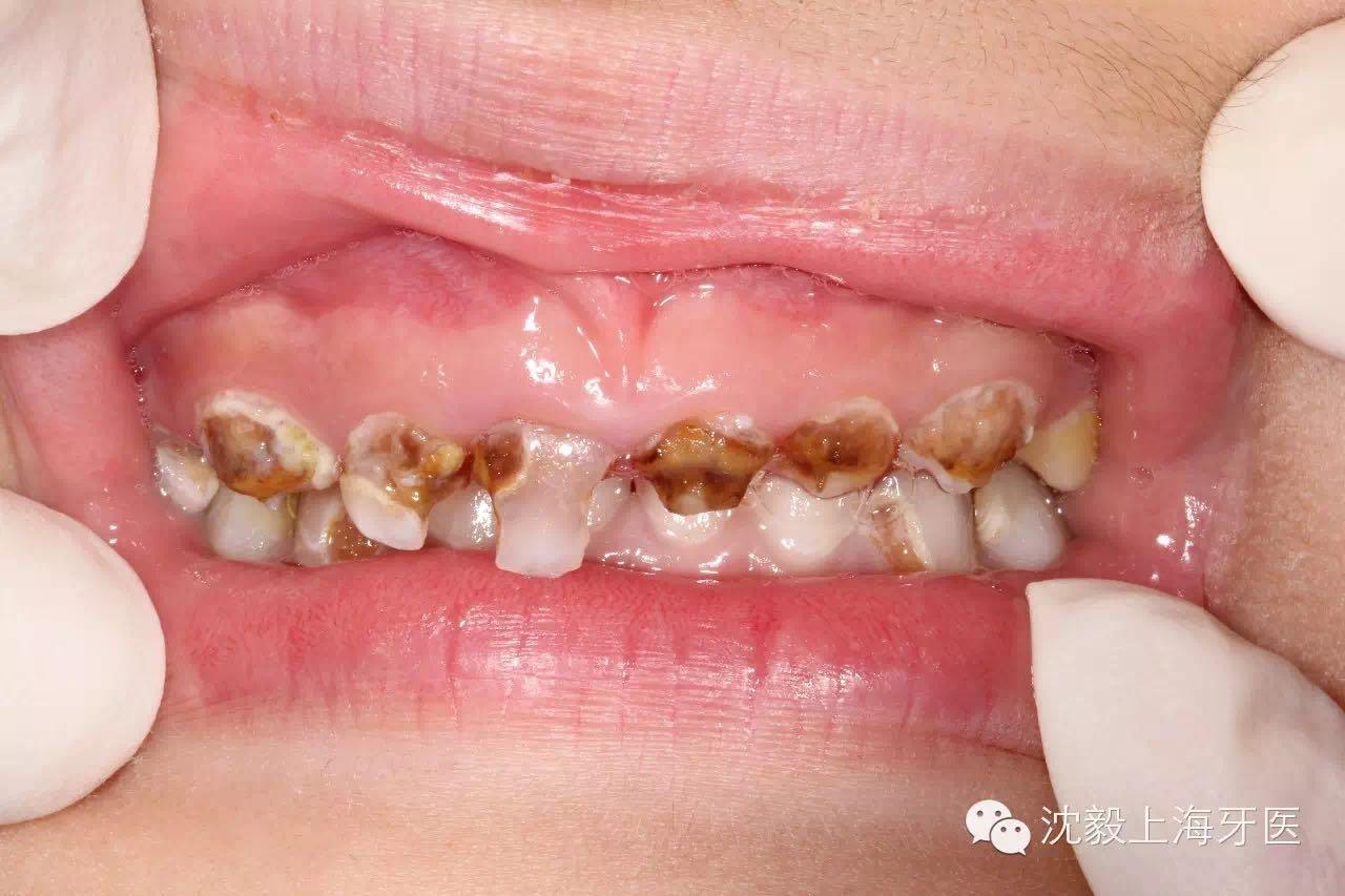 22个月宝宝奶瓶龋门牙掉了一半有什么好办法防止恶化伤到神经