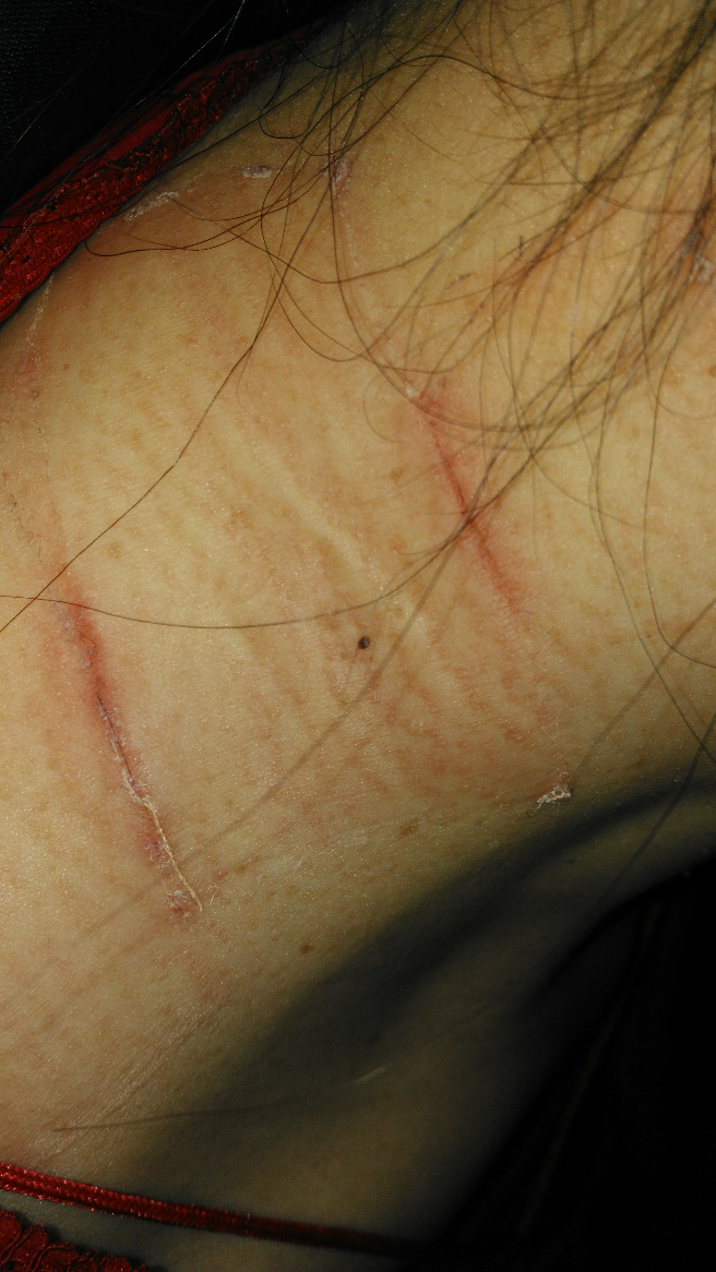 颈子痛贴了麝香壮骨膏三天,结果有伤痕,为什么