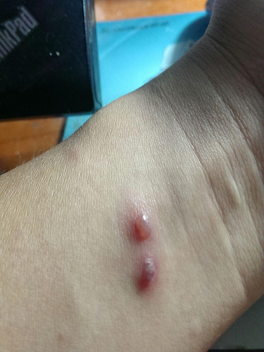 带状疱疹的诱因是什么如何有效治疗