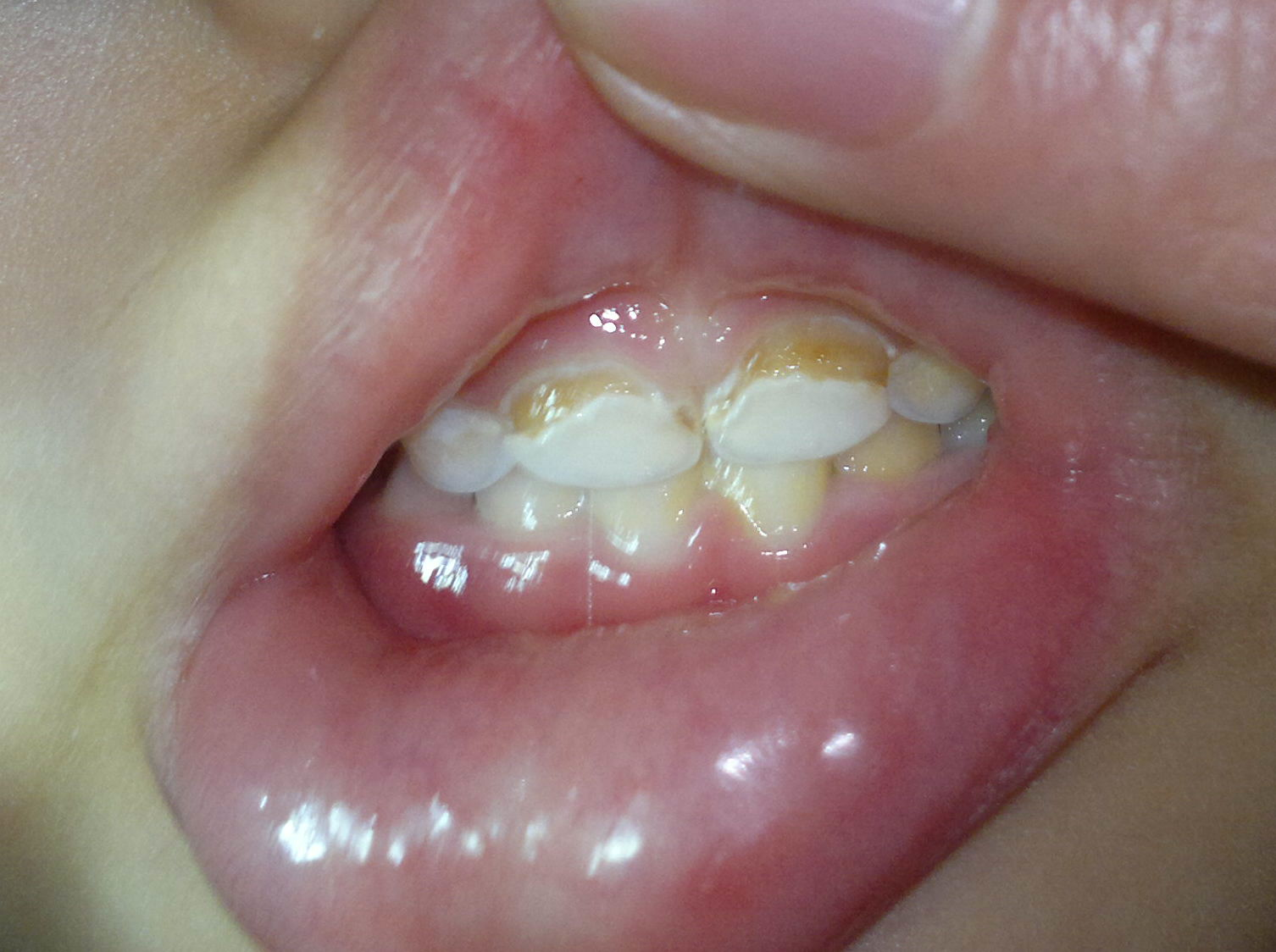 牙釉质发育不完全是怎么变成这样的?换牙会好吗?四岁半孩子? 