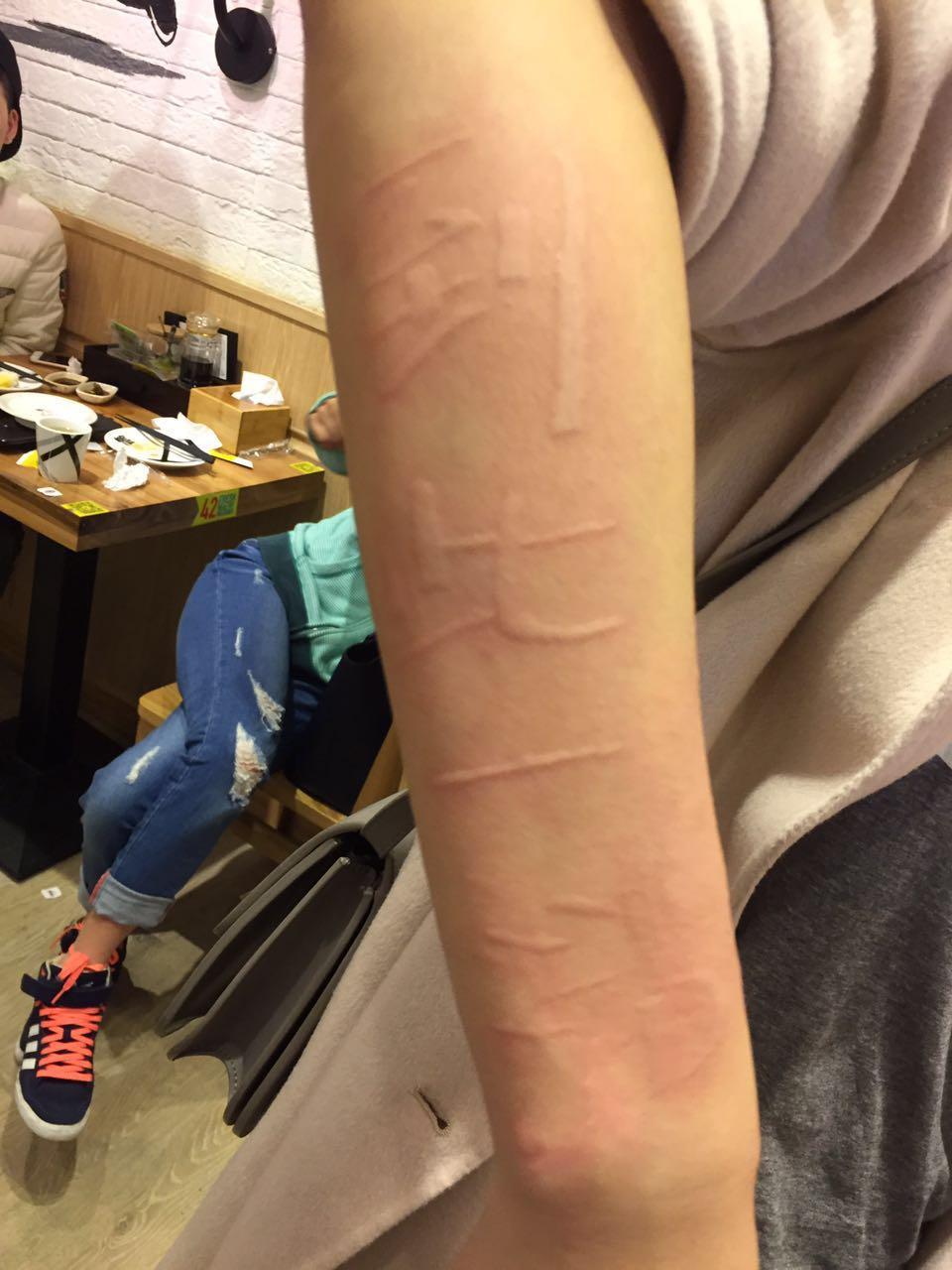 人工荨麻疹(皮肤划痕症)的原理是什么?有治疗的必要么?