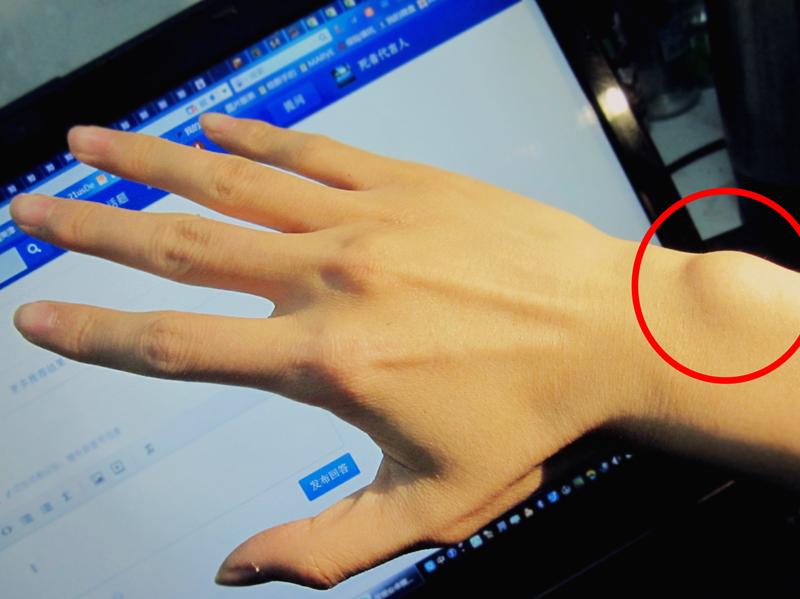 是手腕外侧靠近小指 而且左右手都有好久了按下去不痛. - 知乎