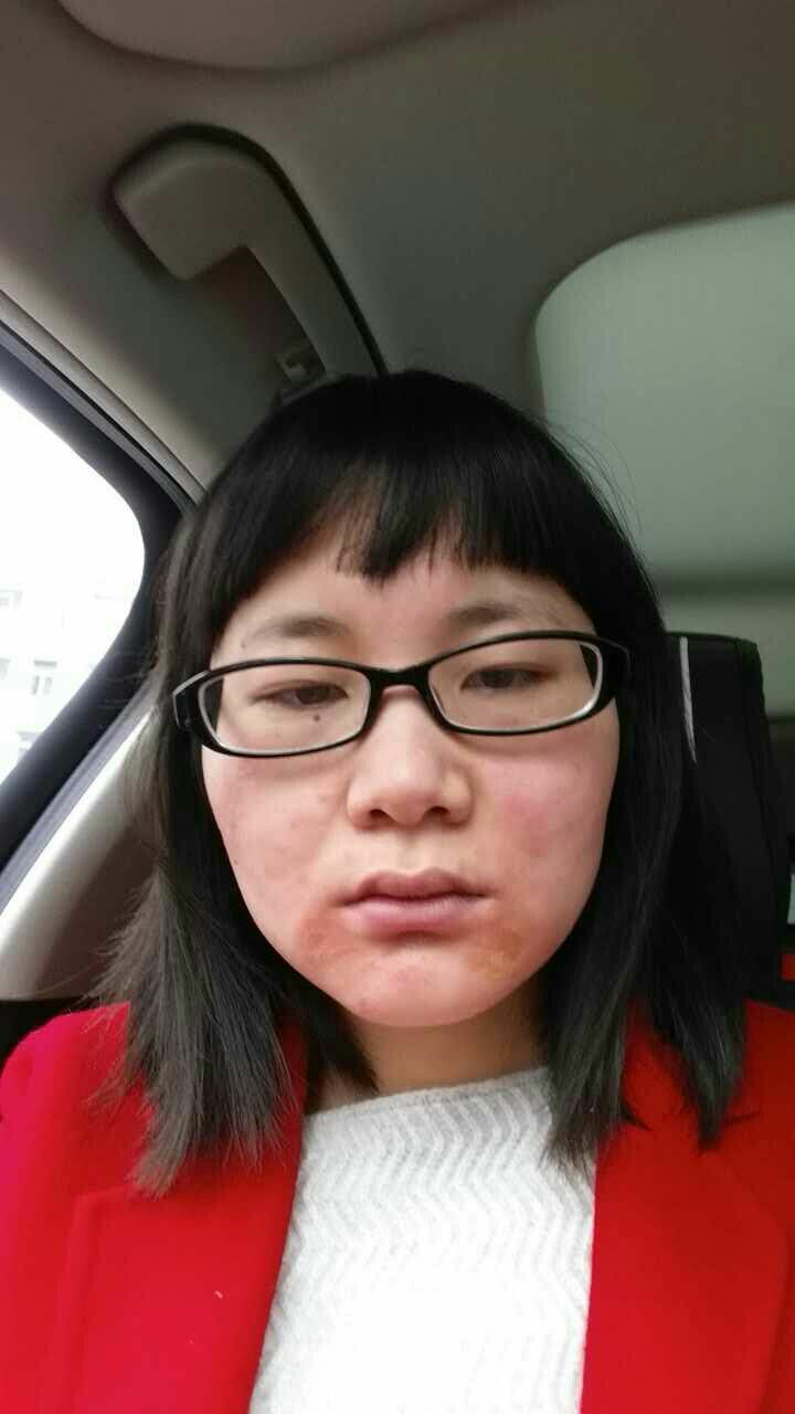 激素依赖性皮炎通常如何治疗? - 胡玲的回答 -