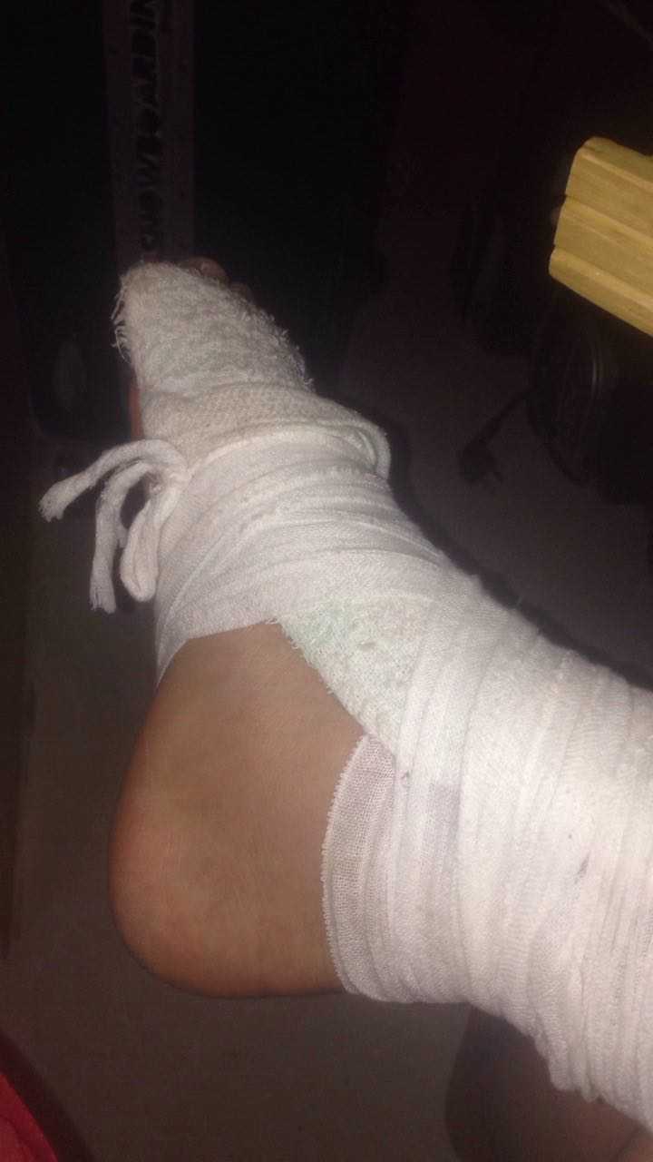 跟腱断裂之后 手术是如何接上的呢 知乎 跟腱断裂之后 手术是如何接上的呢 知乎