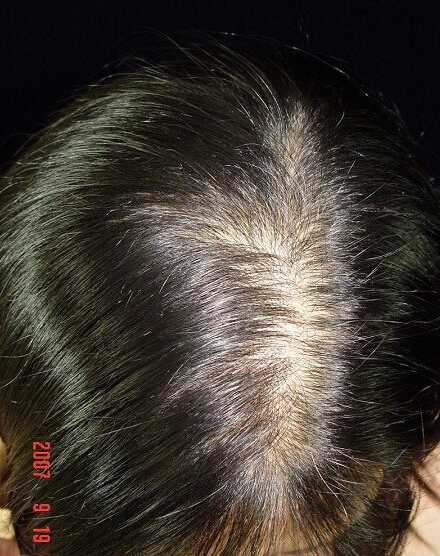 这位女性就是弥散性脱发，致病原因一般也是雄性激素引起的，女性体内也