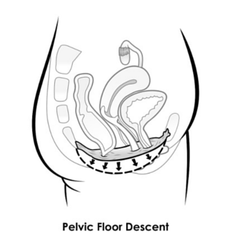 膨胀或者下拉盆底肌(如图示黑色箭头所示)