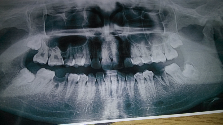 智齿能不能矫正到七号牙使用?