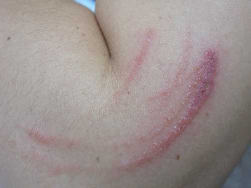 网上传言的香港隐翅虫及其毒害,是真的吗?