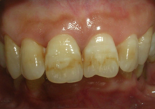 牙釉质发育不完全是怎么变成这样的?换牙会好吗?四岁半孩子?