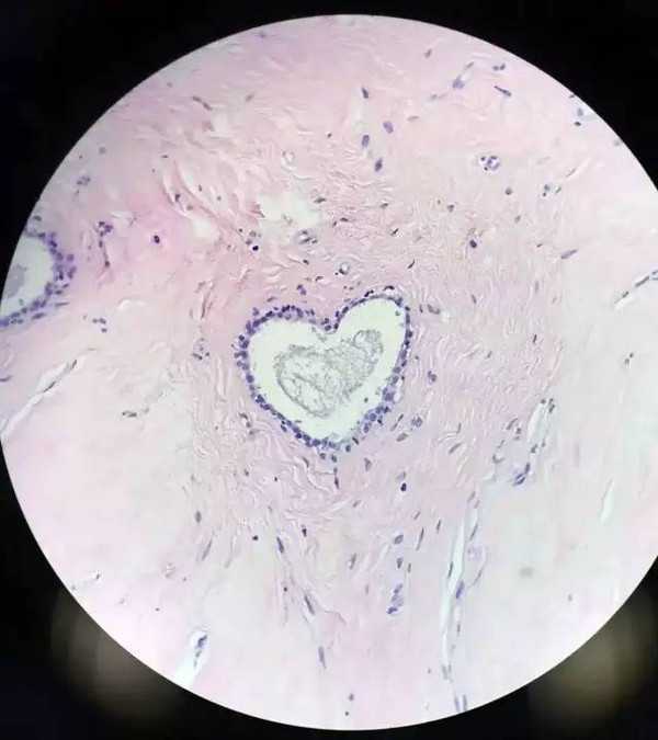 显微镜下有完全不同的长相  病理医生做的工作就是根据这些细胞的不同