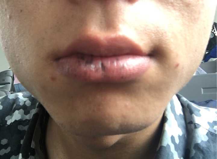 嘴唇上最近长了几个黑点 像痣又像斑 怎么能去除?