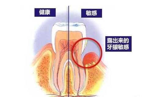 洗牙的过程是怎样的 洗牙后有哪些需要注意的 知乎