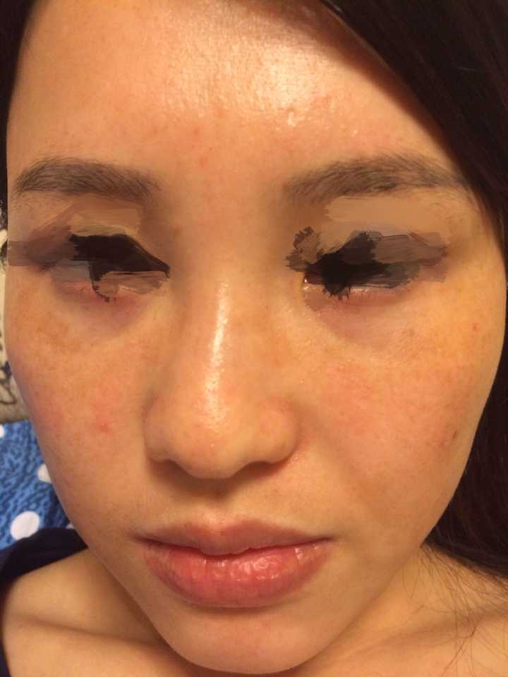 20岁,脸上有斑,越来越多,皮肤暗黄,眼角还有皱纹,主要是斑怎么办?