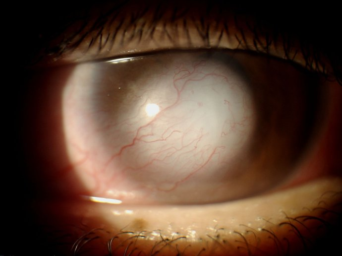 角膜瘢痕图片