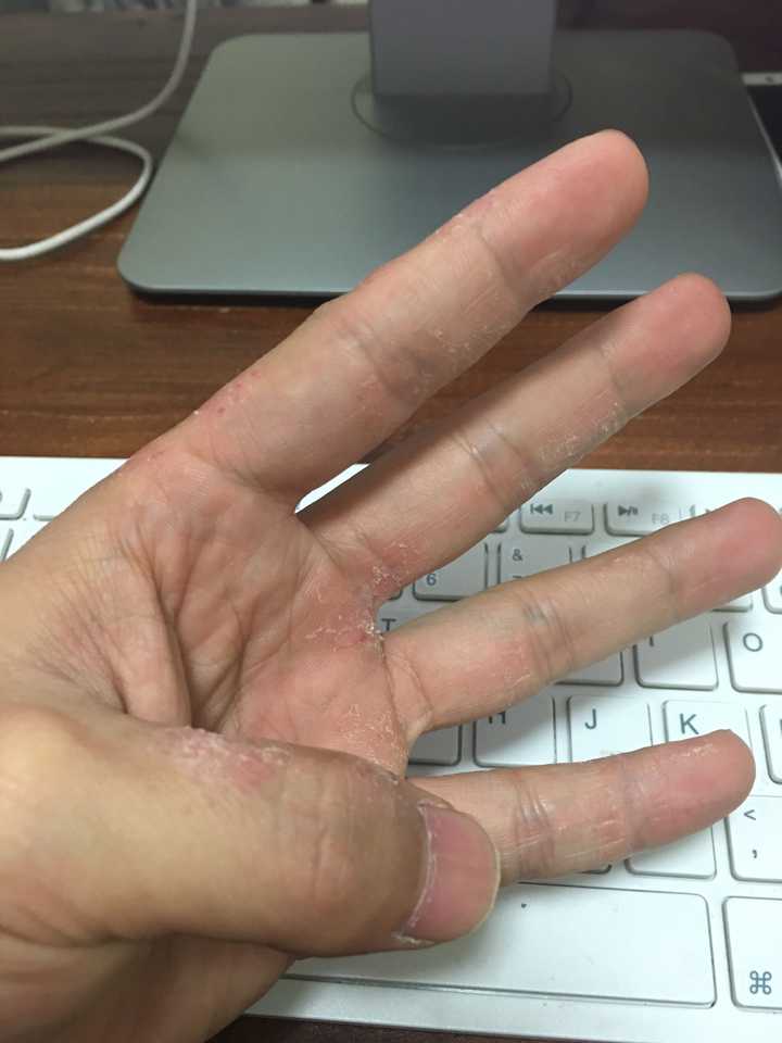 手掌长期脱屑,脚趾间也有,持续几年,用什么药都没有改善,去医院检查