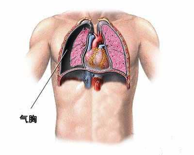 用力导致胸腔受压也可能导致此病发生. 气胸的原理如下图示