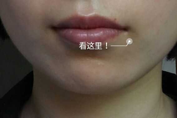 如何去除嘴角的黑色素 知乎