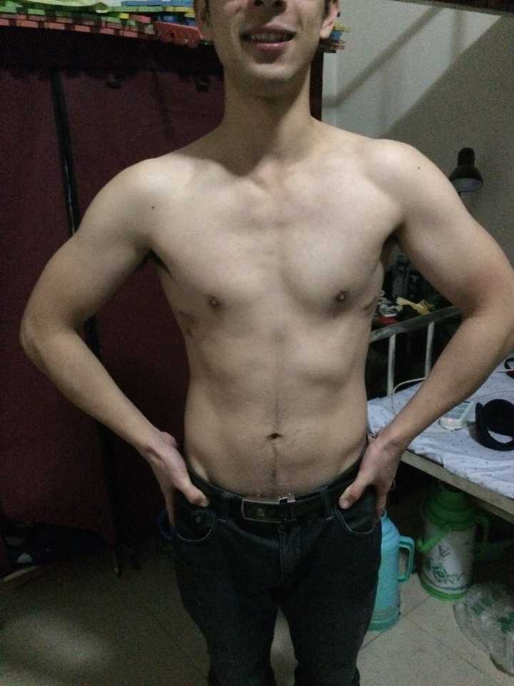 漏斗胸可以通过身体锻炼矫正过来吗? 知乎