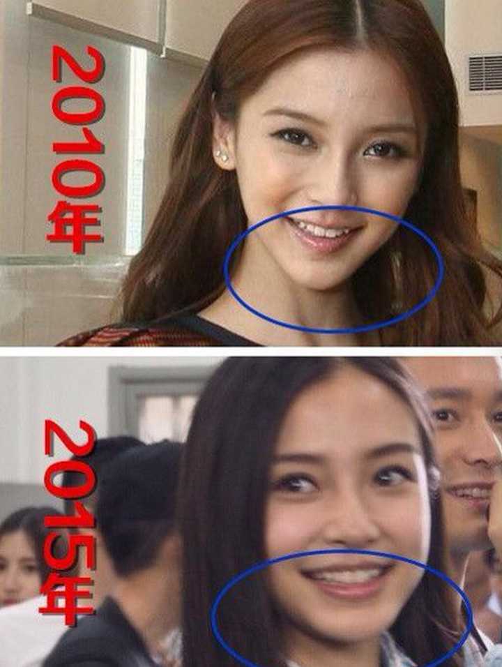 angelababy 鉴定整容真实性有多大?