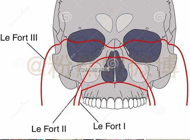 没记错的话安氏二类是上突下缩,手术方法是上颌骨行lefort1前徙术