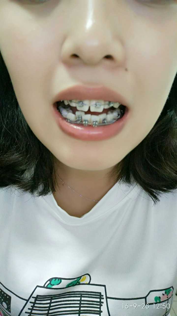 今天去复诊了,下牙套了小铁环出现了点变化,两颗小牙不知不觉出来了一