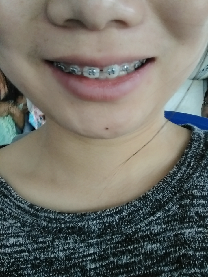 我有轻微龅牙,不是很明显,但是心病,究竟要不要做正畸?