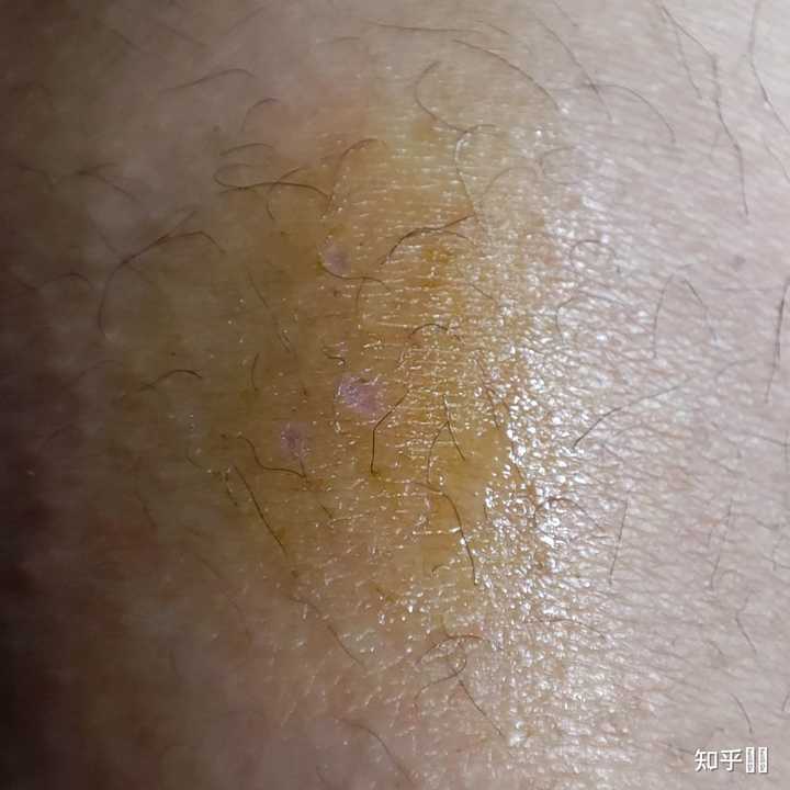 骑车摔倒擦伤怎么快速修复啊? - 知乎