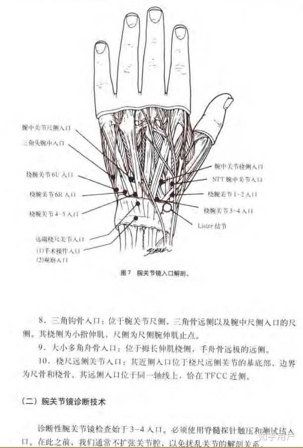 三角纤维软骨(tfcc)损伤,该如何治疗和康复呢? - 知乎