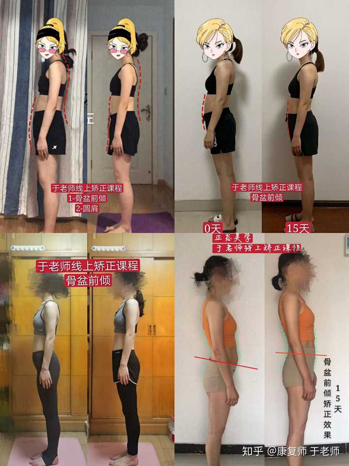 骨盆前倾有矫正成功的例子吗 知乎 骨盆前倾有矫正成功的例子吗 知乎