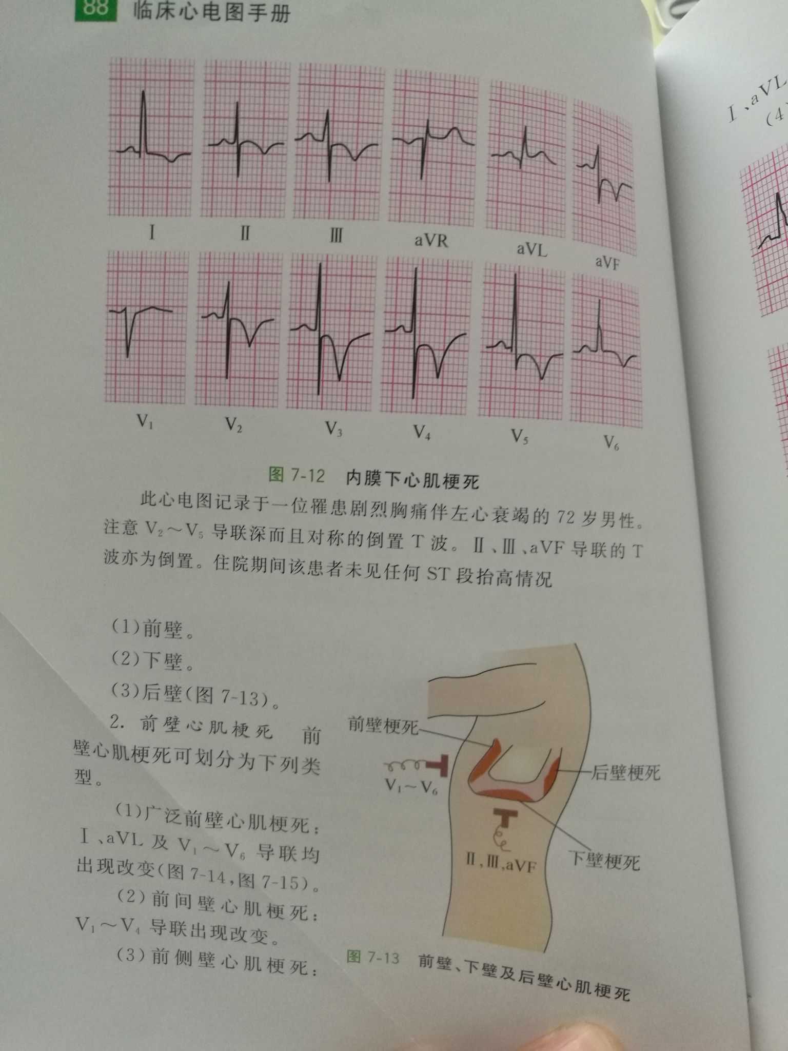 v6导联是前侧壁 v1-v3导联是前间壁 v2-v4导联是前壁 ii,iii,avf导联