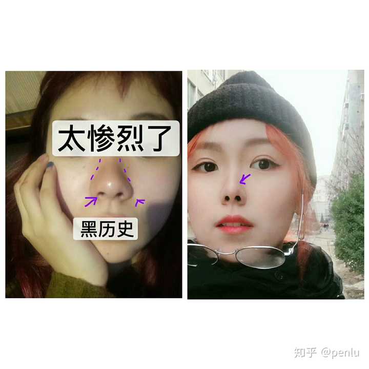 之前大小鼻孔,鼻孔特别的大,鼻头肉