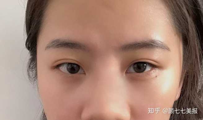 姑娘之前打过玻尿酸,鼻背比较宽,鼻头偏大